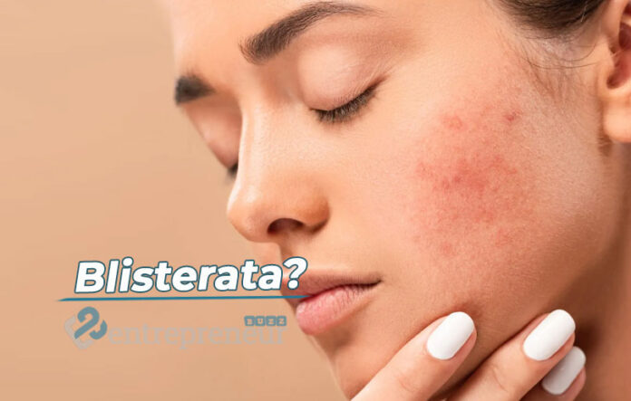 How to Treat Blisterata: Causes and Solutions?