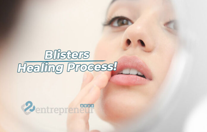 How to Speed Up the Healing Process of blisterata